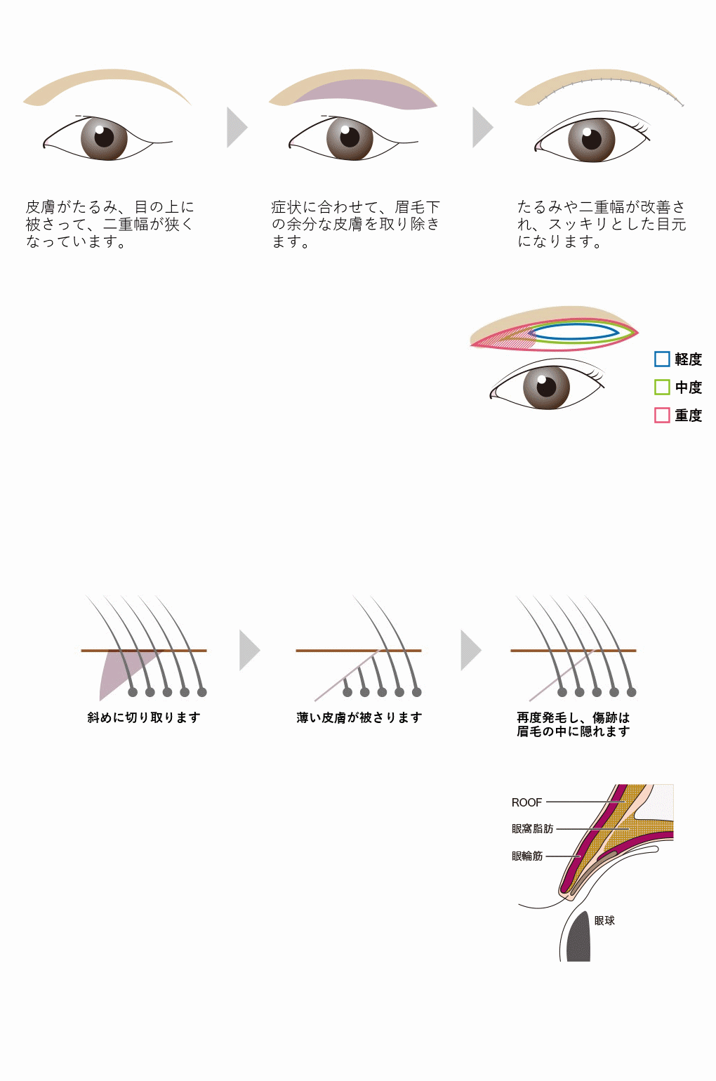 眉下切開リフト