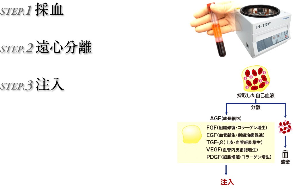 ボトックス注射