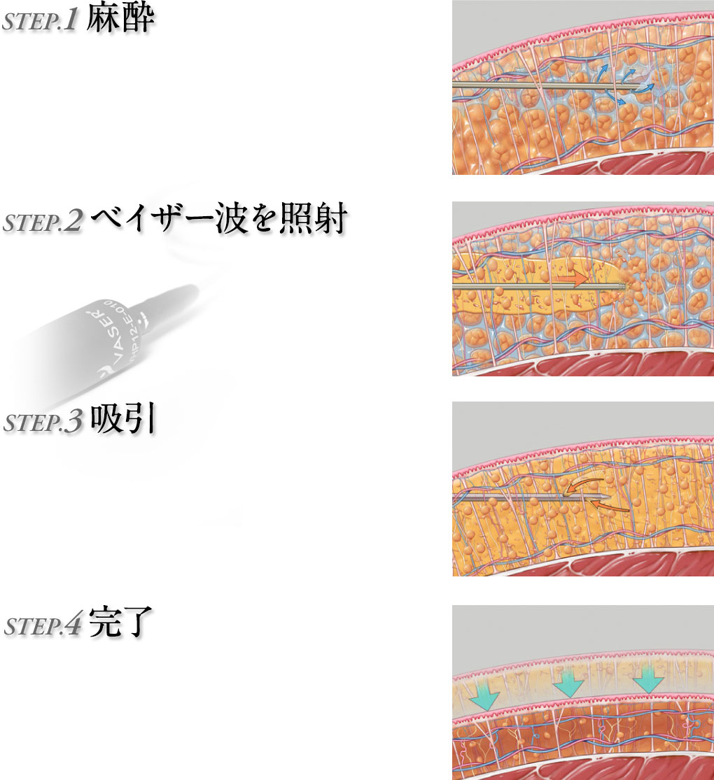 80％にまで高められた脂肪生着率／高い安全性とナチュラルな感触／ベイザー脂肪吸引との組み合わせでハイグレードな仕上がり