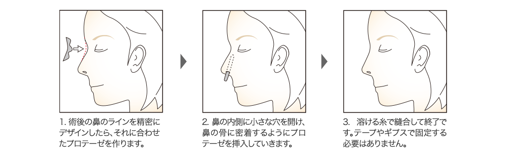 隆鼻術