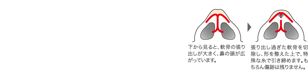 さまざまな鼻の整形