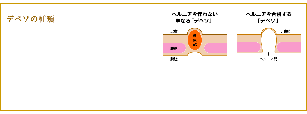 でべその種類