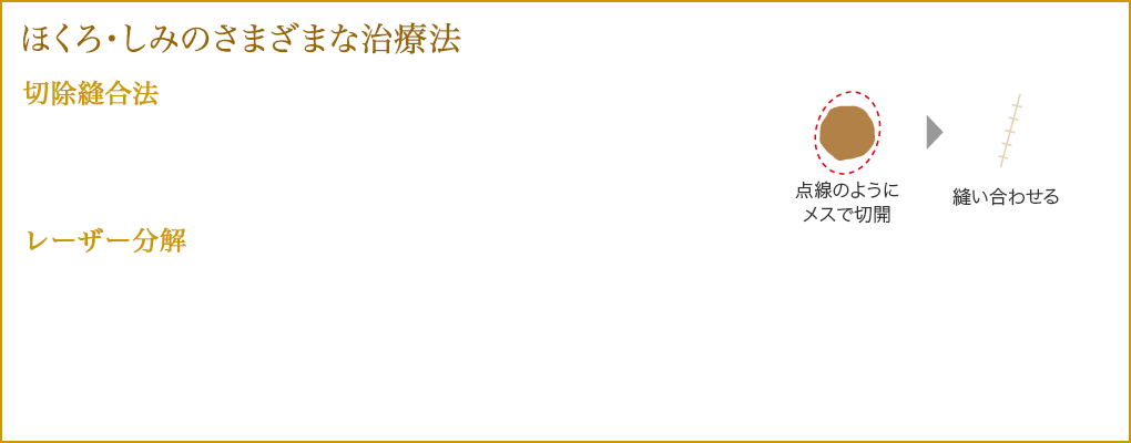 ほくろ・しみのさまざまな治療法 切除縫合法/レーザー分解