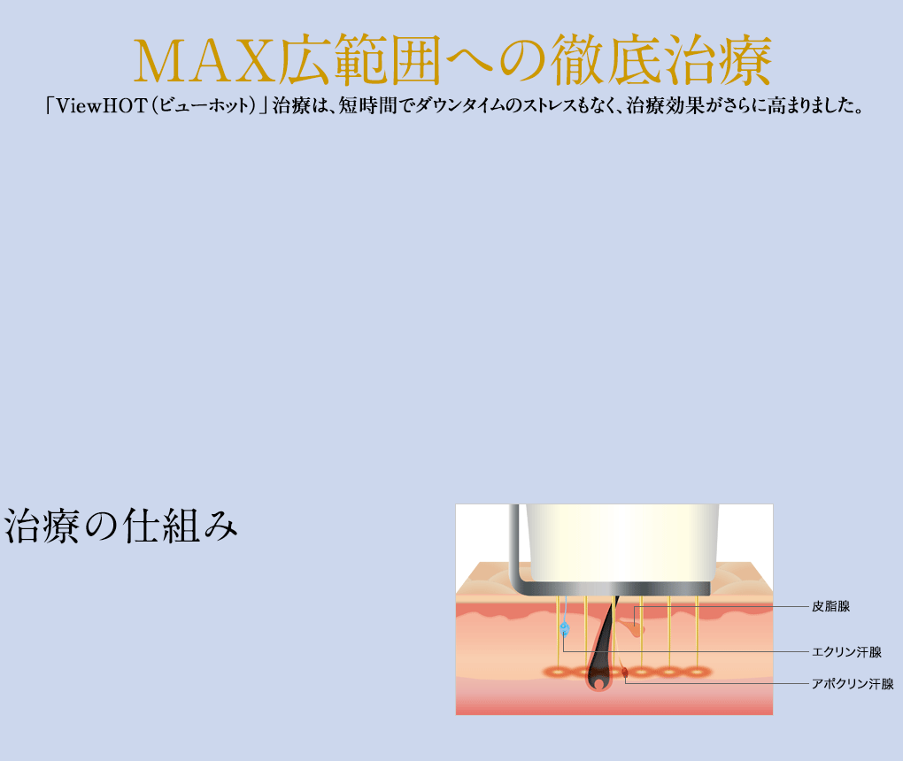 MAX広範囲への徹底治療「ViewHOT(ビューホット)」治療は、短時間でダウンタイムのストレスもなく、治療効果がさらに高まりました。