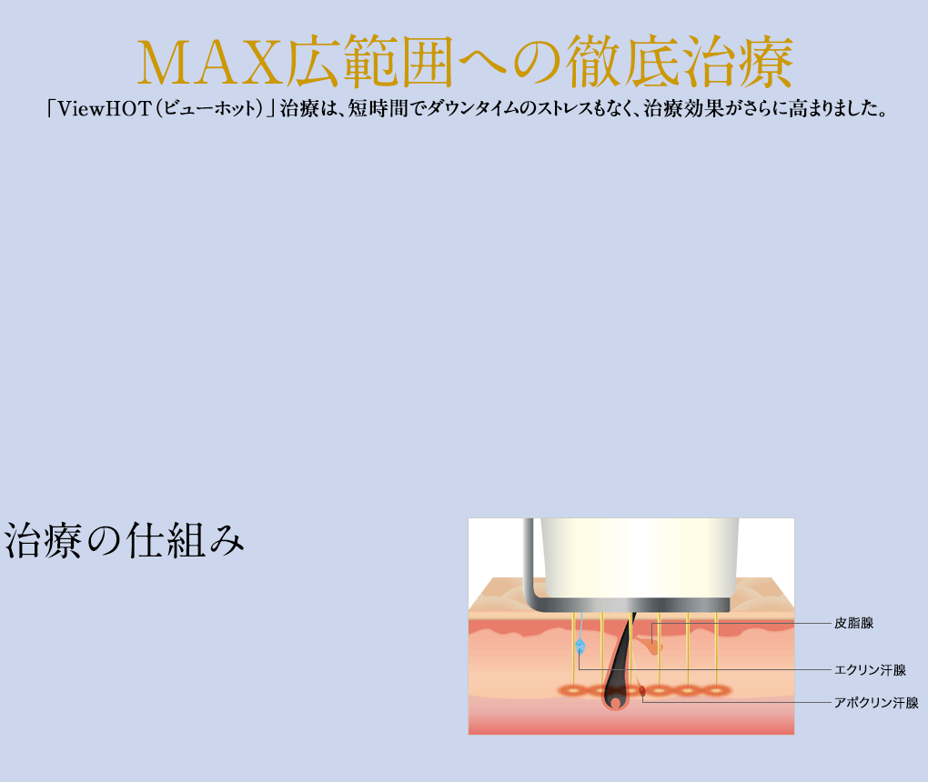 MAX広範囲への徹底治療「ViewHOT（ビューホット）」治療は、短時間でダウンタイムのストレスもなく、治療効果がさらに高まりました。