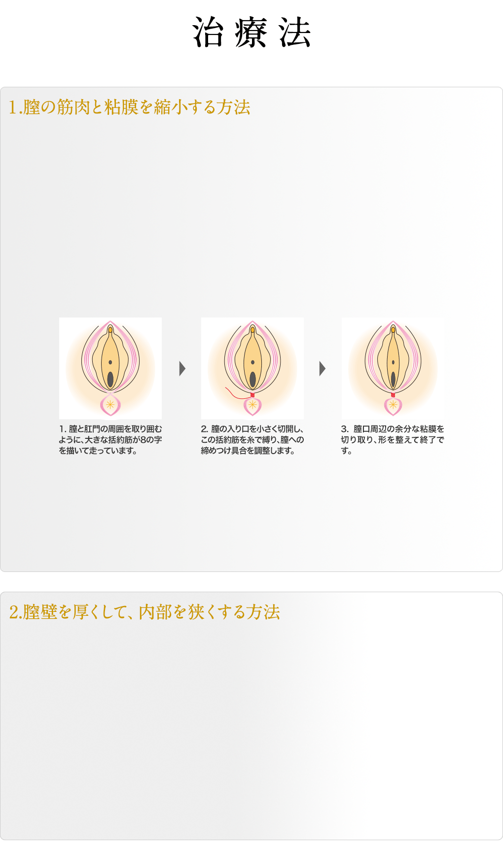 膣縮小