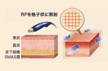 2. GFR（イントラジェン）